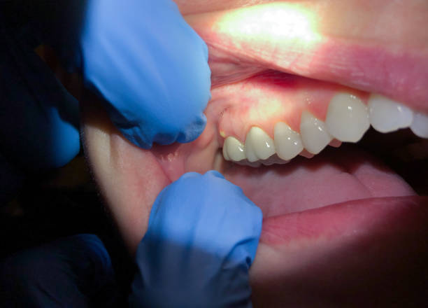 Best Broken or Chipped Tooth Repair in Candler Mcafee, GA